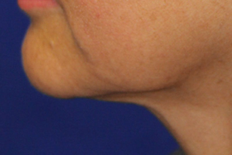 face tite procedure lower jaw side view