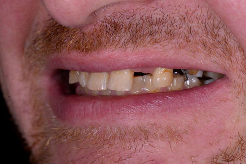 dental implant before