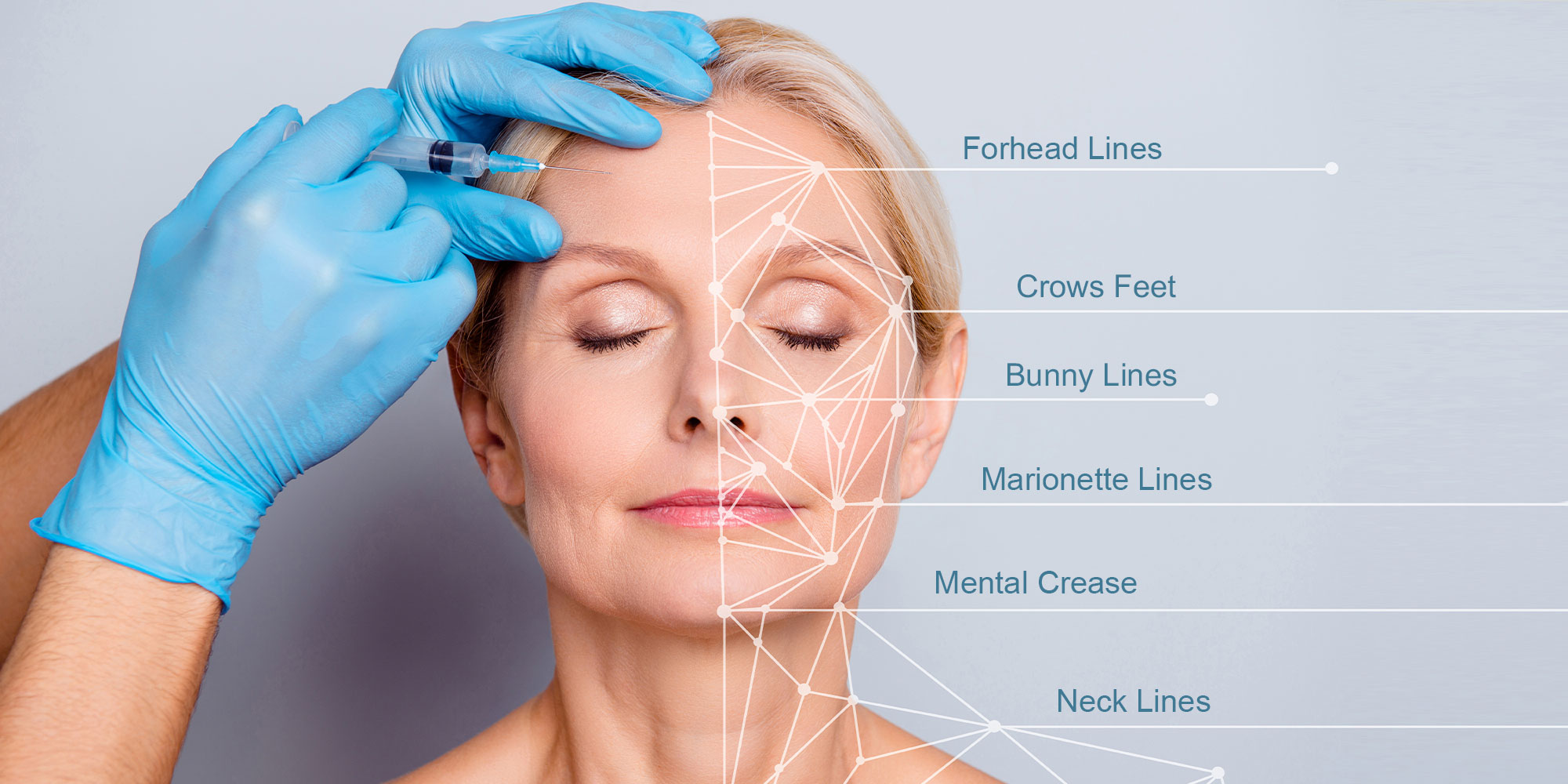 BOTOX graphic with labels