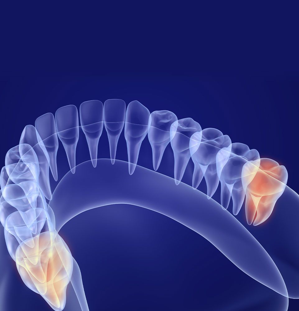 wisdom tooth extraction